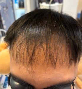Denser and Thicker Hair after LLLT Treatment