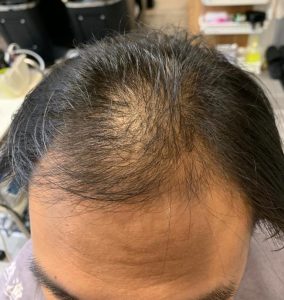 Hair Thinning Before LLLT Treatment