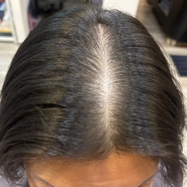 Improving Hairline after Exosome Treatment