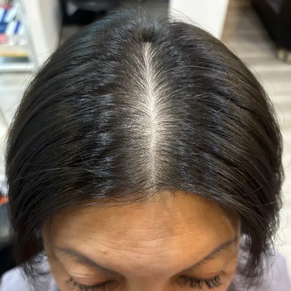 Further Hairline Improvement after Exosome Treatment