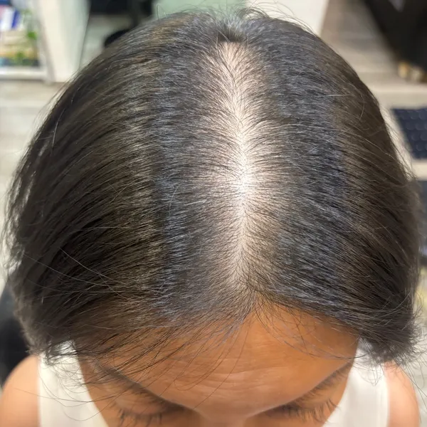 Original Condition - Widening Hairline
