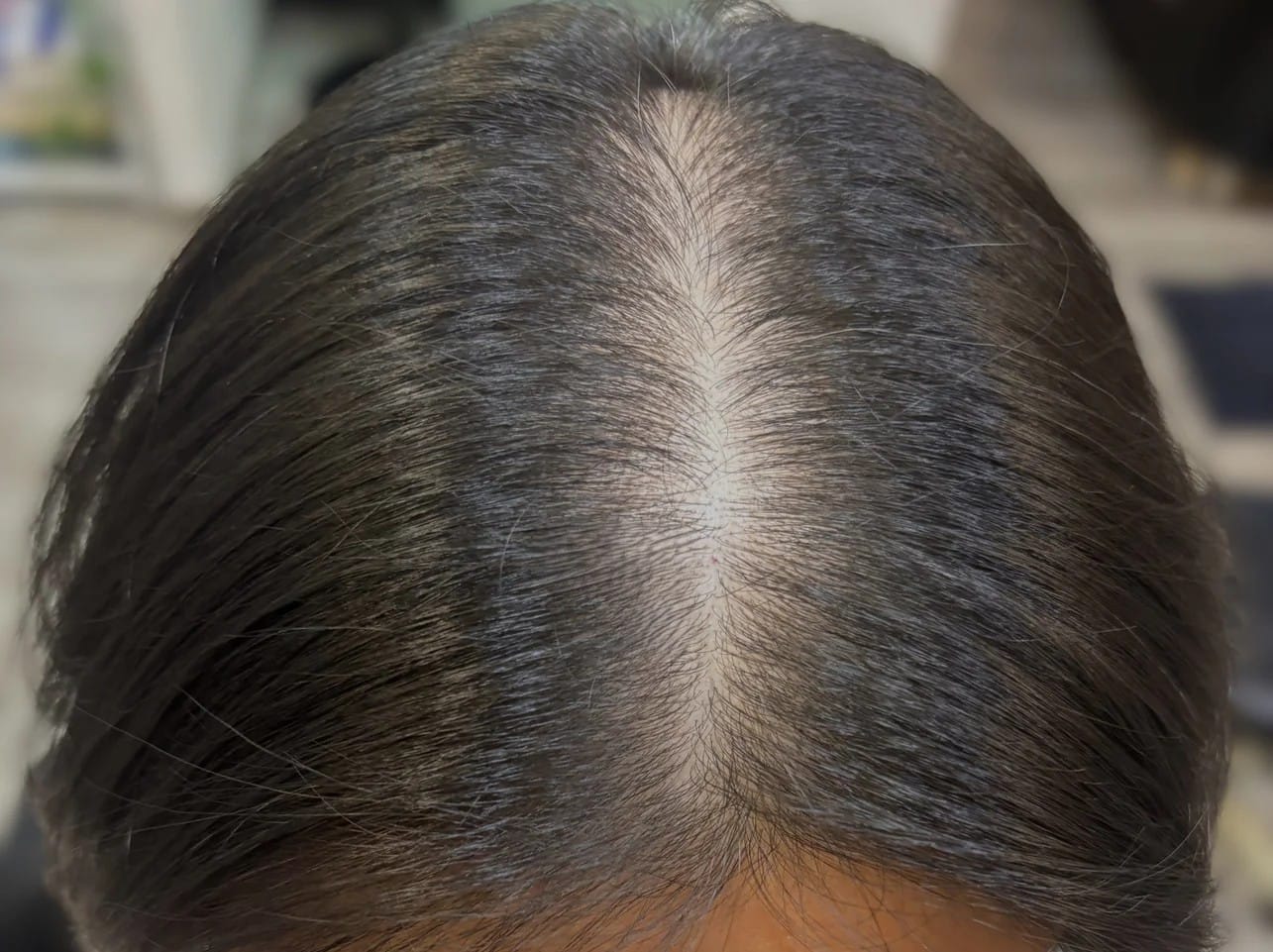 Female hair thinning - parting Thinning at the hair parting in women