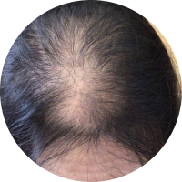 Hair Loss and Thinning Condition