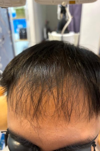 Hair densified after LLLT