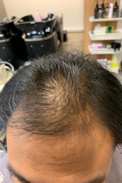 Hair Condition before LLLT Treatment