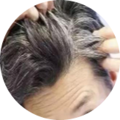 Premature Grey Hair